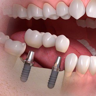 Implante dental de última generación colocado profesionalmente