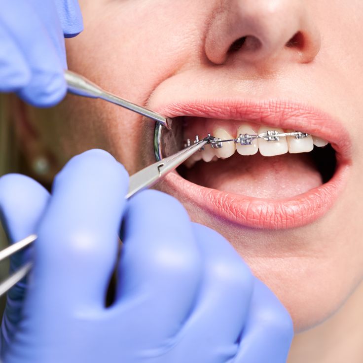 Tratamiento de ortodoncia con brackets y alineación dental
