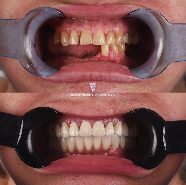 Rehabilitación oral completa con coronas y prótesis dentales